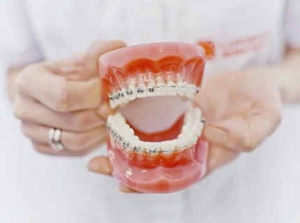 types of dental braces on typodont