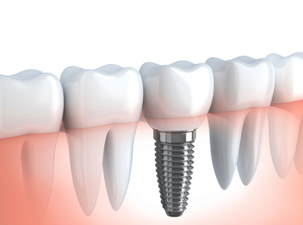 dental implant for tooth replacement