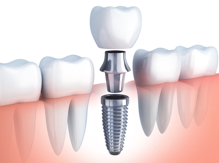 dental implant single tooth