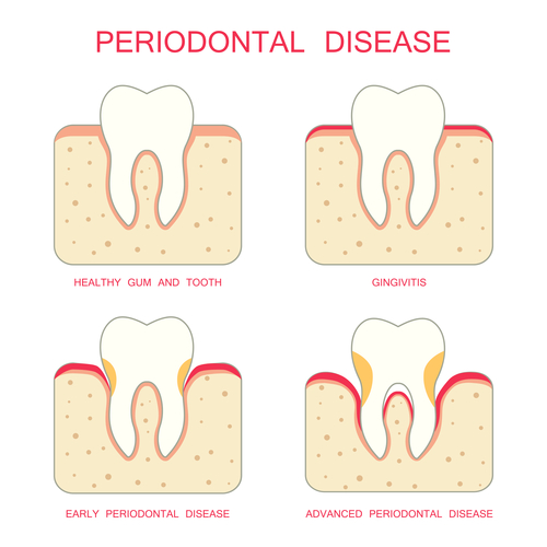 diagram of scaling and root planing for gum disease