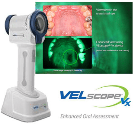 velscope enhanced cancer screening tool and images