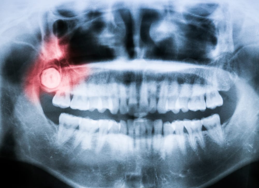 Xray Of Impacted Wisdom Tooth That Must Be Removed 